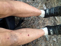 Three Days Worth Of Scratches And Bruises